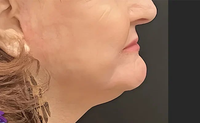 Facelift after surgery – Murrieta Facial Plastic Surgery, case 7
