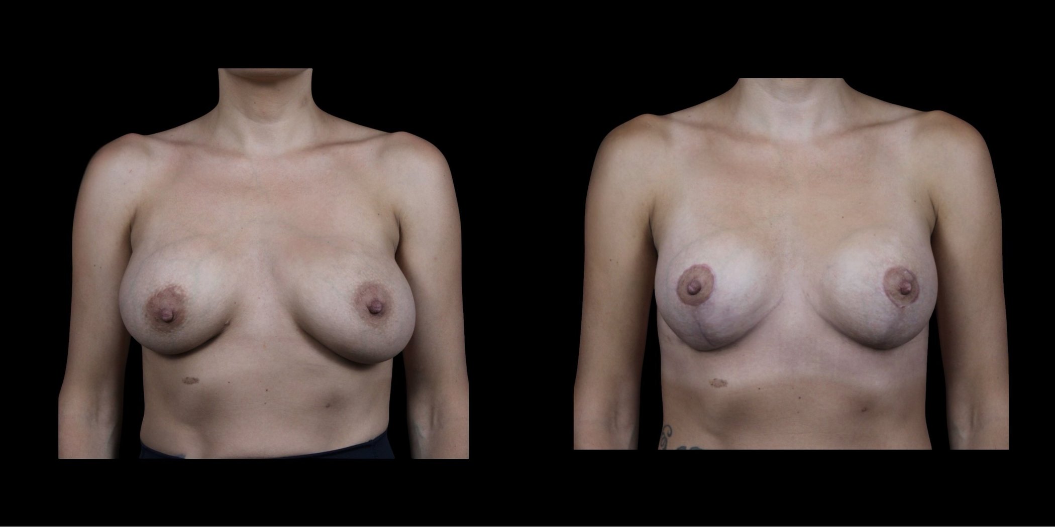 Augmentation Mastopexy before-and-after composite, Consona Plastic Surgery – case 1, view 1