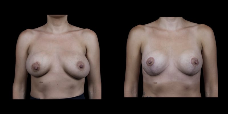 Augmentation Mastopexy before-and-after composite, Consona Plastic Surgery – case 1, view 1