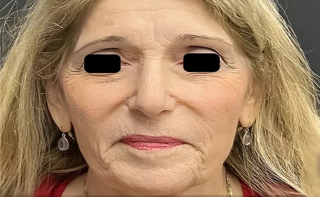 Facelift before surgery – Murrieta Facial Plastic Surgery, case 4