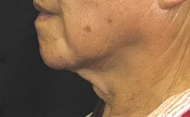 Neck Lift before surgery – Murrieta Facial Plastic Surgery, case 5