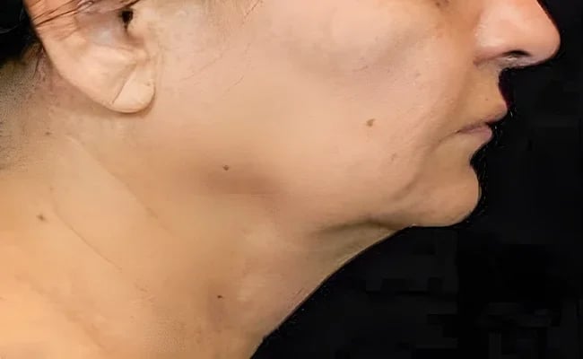 Facelift before surgery – Murrieta Facial Plastic Surgery, case 3