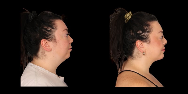 Chin Augmentation before-and-after composite, Consona Plastic Surgery – case 1, view 1