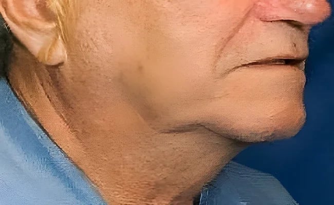 Facelift before surgery – Murrieta Facial Plastic Surgery, case 23