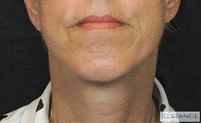 Neck Lift after surgery – Murrieta Facial Plastic Surgery, case 4