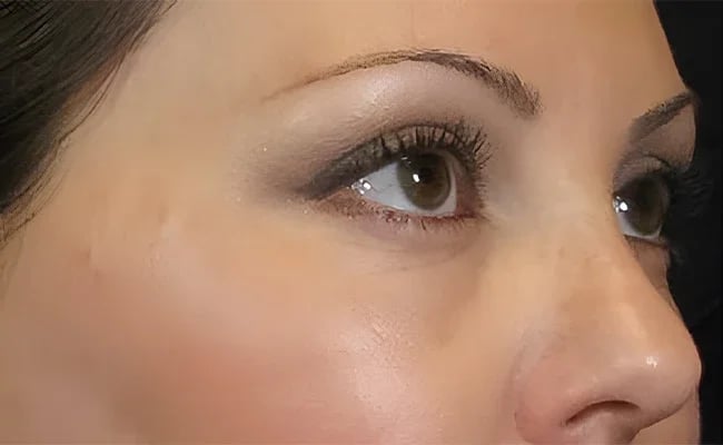 Facelift before surgery – Murrieta Facial Plastic Surgery, case 21