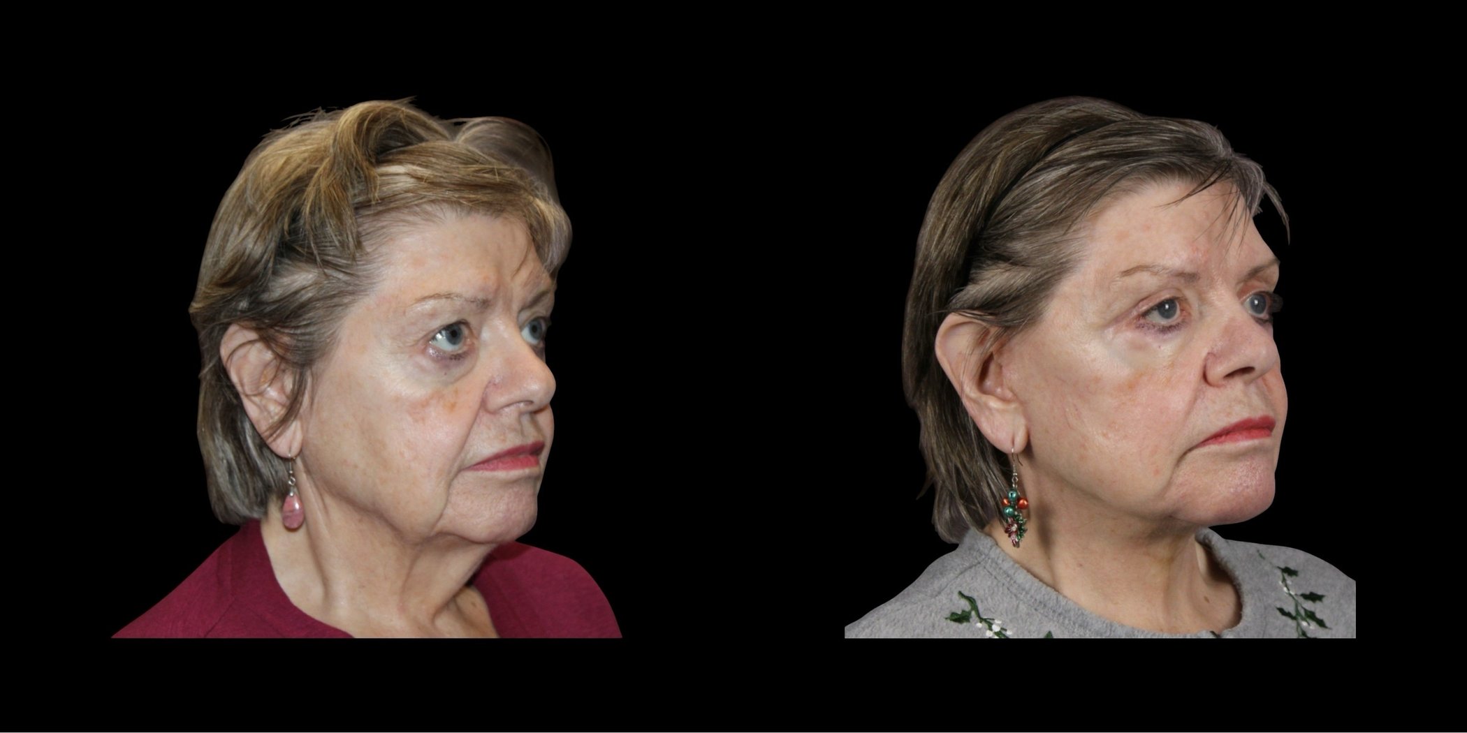 Face & Neck Lift before-and-after composite, Consona Plastic Surgery – case 2, view 2
