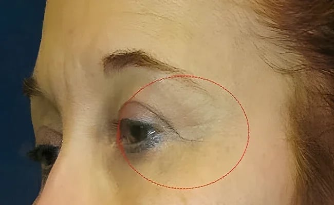 Eyelid Surgery before surgery – Murrieta Facial Plastic Surgery, case 6
