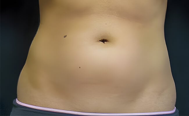 Liposuction before surgery – Murrieta Facial Plastic Surgery, case 6