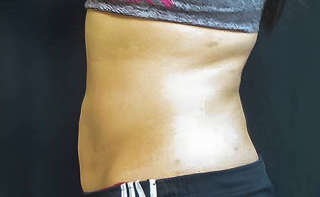 Liposuction after surgery – Murrieta Facial Plastic Surgery, case 7