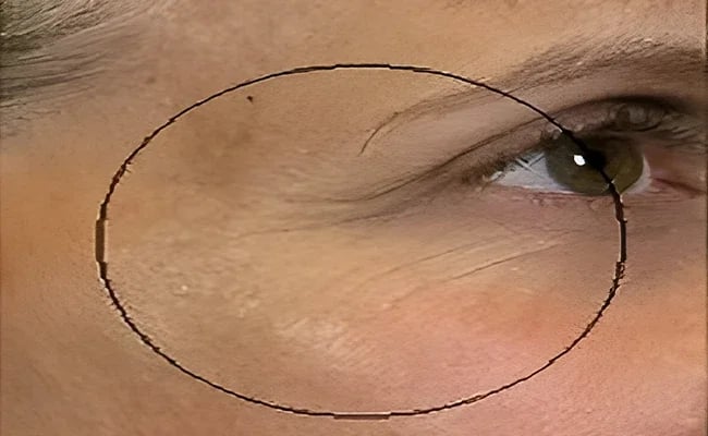 Eyelid Surgery before surgery – Murrieta Facial Plastic Surgery, case 13