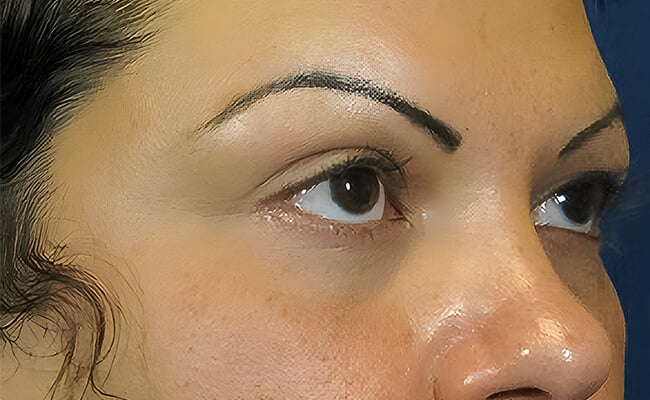 Vampire Facelift before treatment – Murrieta Facial Plastic Surgery, case 2