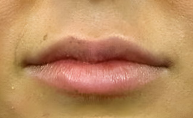Fillers after treatment – Murrieta Facial Plastic Surgery, case 4