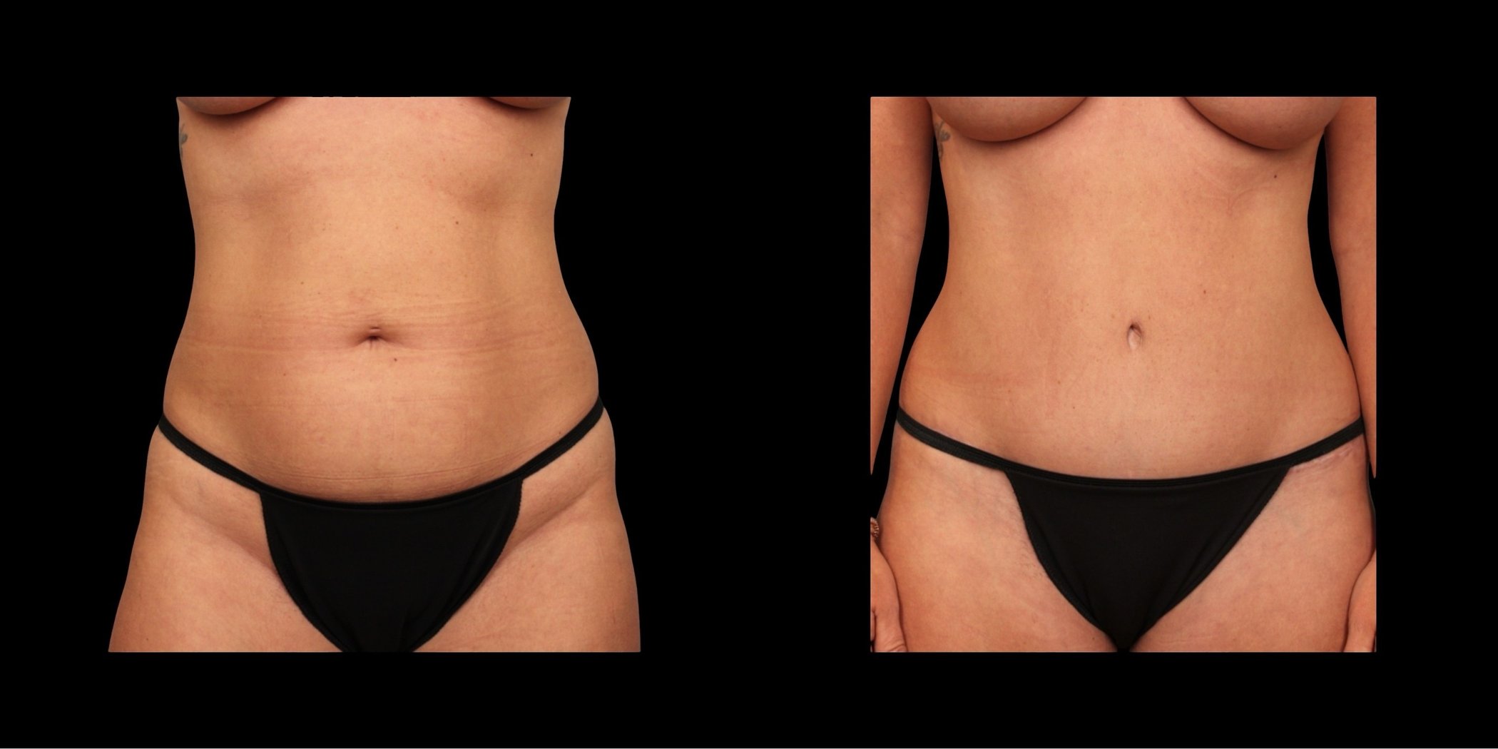 Abdominoplasty before-and-after composite, Consona Plastic Surgery – case 1, view 1