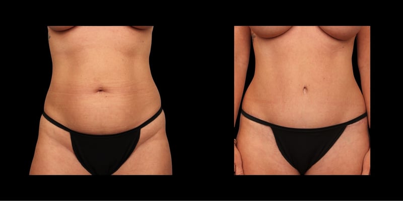 Abdominoplasty before-and-after composite, Consona Plastic Surgery – case 1, view 1