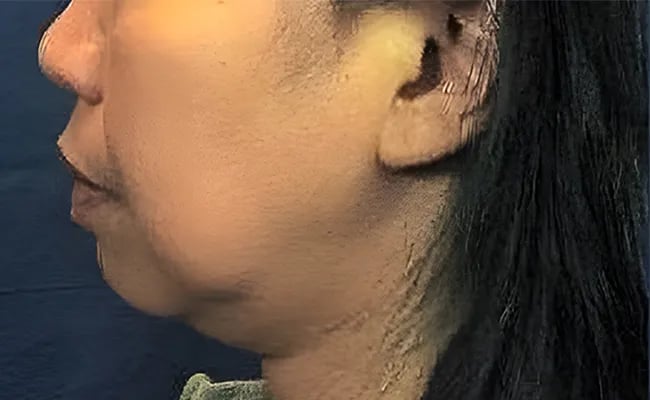 Chin Augmentation before surgery – Murrieta Facial Plastic Surgery, case 4