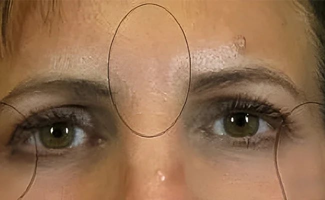 Eyelid Surgery after surgery – Murrieta Facial Plastic Surgery, case 9