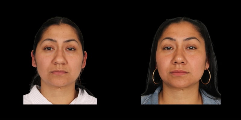 Rhinoplasty before-and-after composite, Consona Plastic Surgery – case 3, view 1