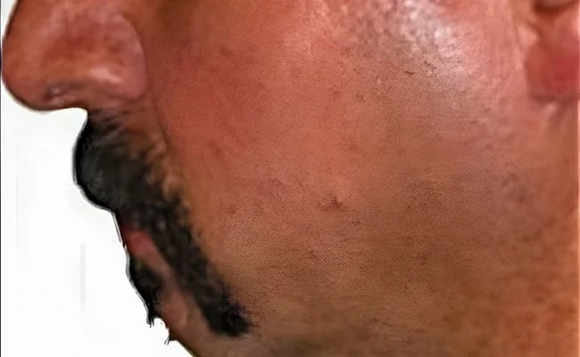 Chin Augmentation before surgery – Murrieta Facial Plastic Surgery, case 5