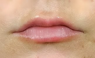 Fillers before treatment – Murrieta Facial Plastic Surgery, case 1