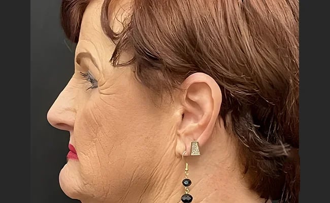 Facelift before surgery – Murrieta Facial Plastic Surgery, case 25