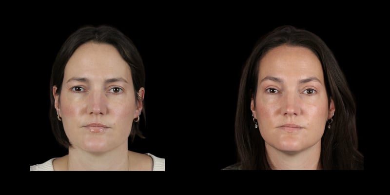 Blepharoplasty before-and-after composite, Consona Plastic Surgery – case 1, view 1