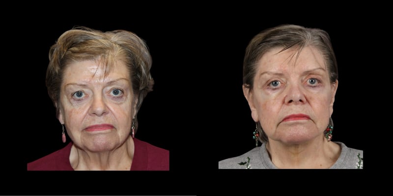 Face & Neck Lift before-and-after composite, Consona Plastic Surgery – case 2, view 1