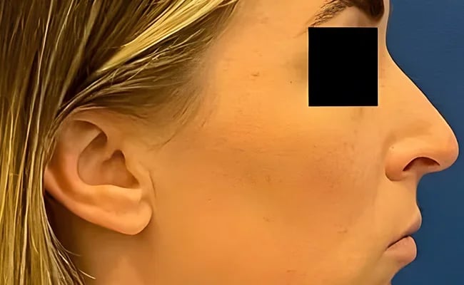 Rhinoplasty before surgery – Murrieta Facial Plastic Surgery, case 2