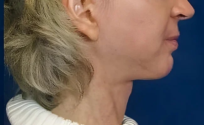 Facelift after surgery – Murrieta Facial Plastic Surgery, case 15