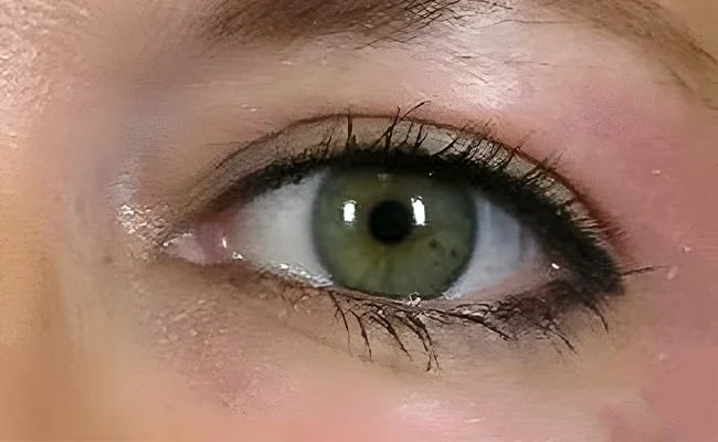 Eyelid Surgery after surgery – Murrieta Facial Plastic Surgery, case 11