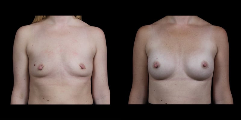 Breast Augmentation before-and-after composite, Consona Plastic Surgery – case 1, view 1