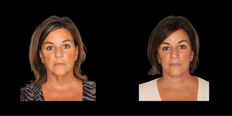 Face & Neck Lift before-and-after composite, Consona Plastic Surgery – case 3, view 1