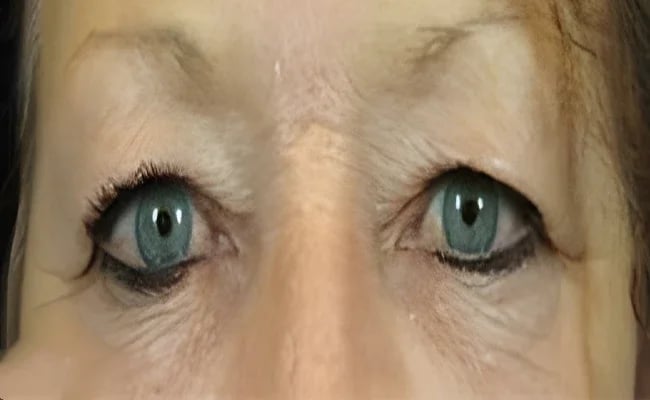 Eyelid Surgery before surgery – Murrieta Facial Plastic Surgery, case 20