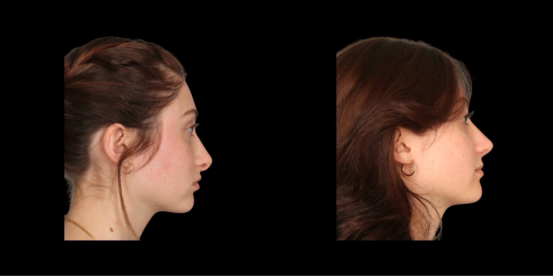 Rhinoplasty before-and-after composite, Consona Plastic Surgery – case 6, view 2