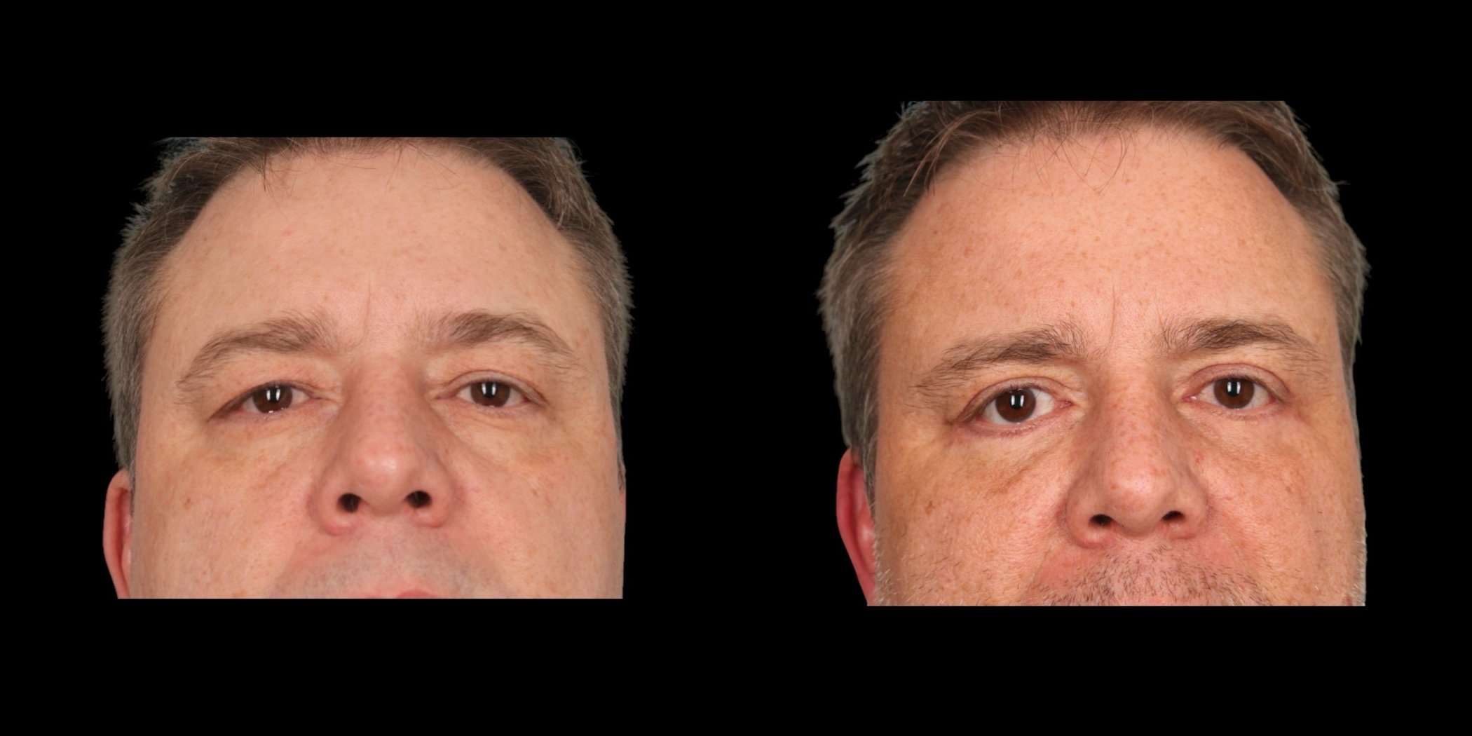 Blepharoplasty before-and-after composite, Consona Plastic Surgery – case 2, view 1