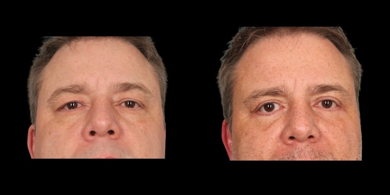Blepharoplasty before-and-after composite, Consona Plastic Surgery – case 2, view 1