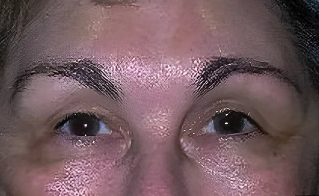 Brow Lift after surgery – Murrieta Facial Plastic Surgery, case 2