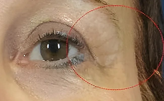 Eyelid Surgery before surgery – Murrieta Facial Plastic Surgery, case 7