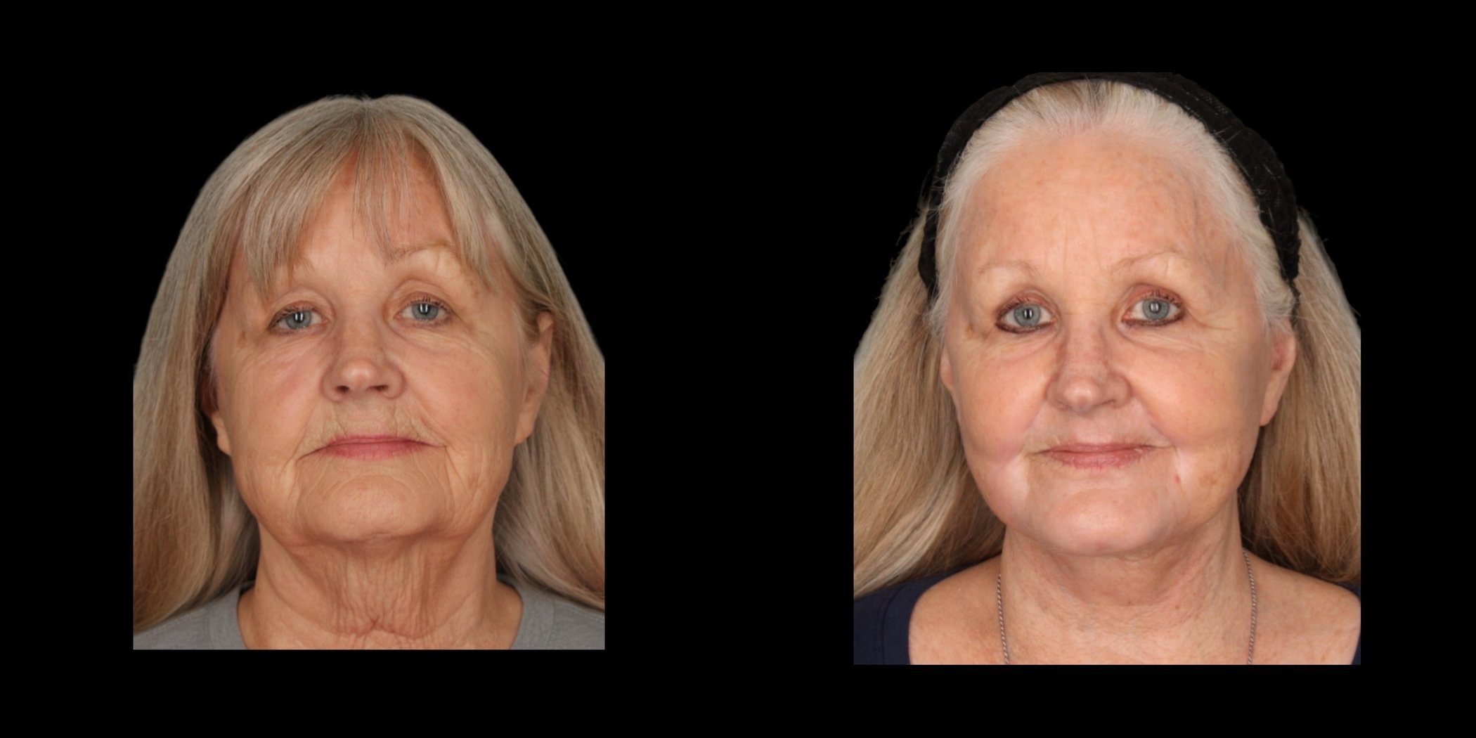 Face & Neck Lift before-and-after composite, Consona Plastic Surgery – case 1, view 2
