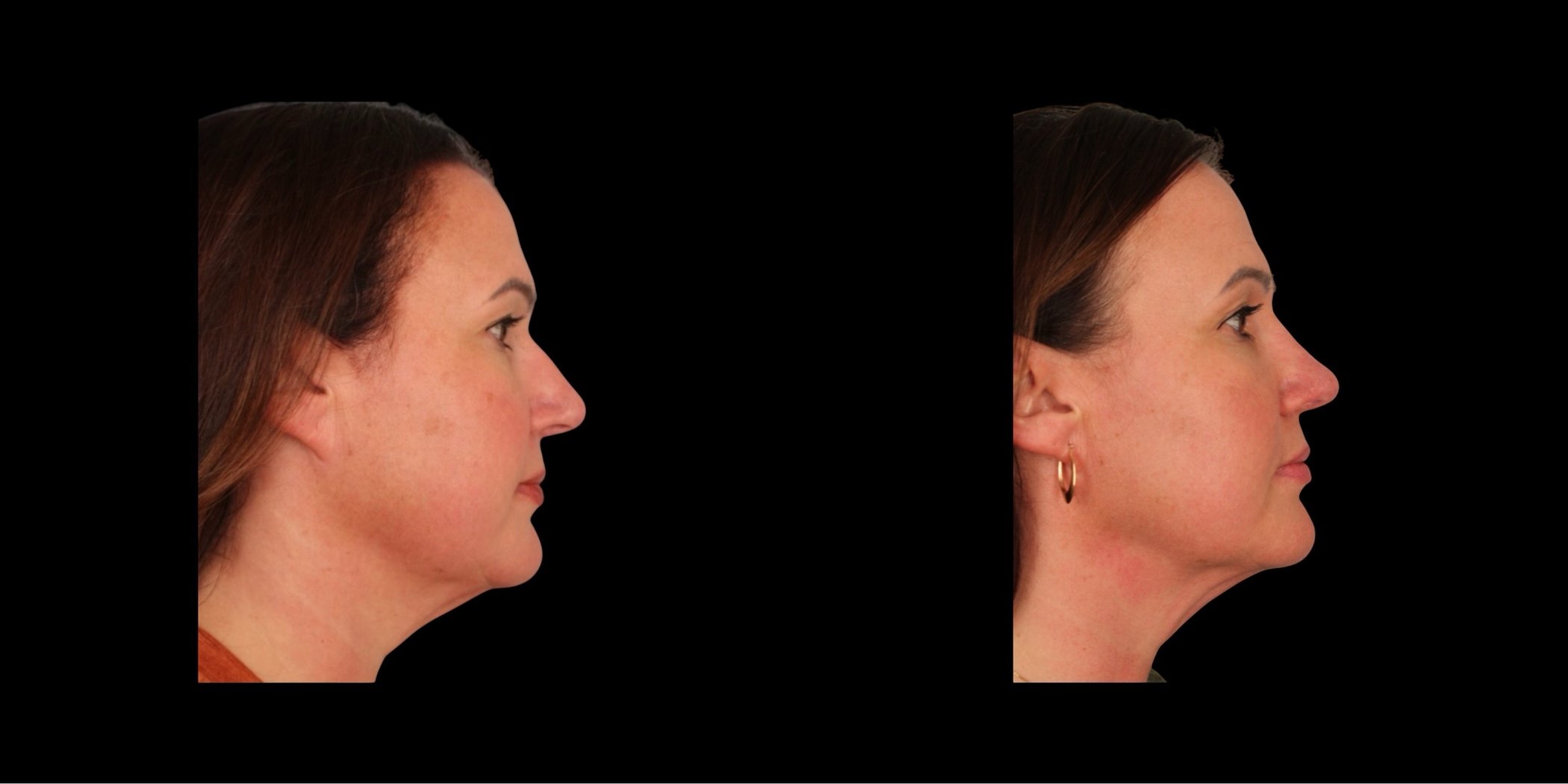 Rhinoplasty before-and-after composite, Consona Plastic Surgery – case 5, view 2