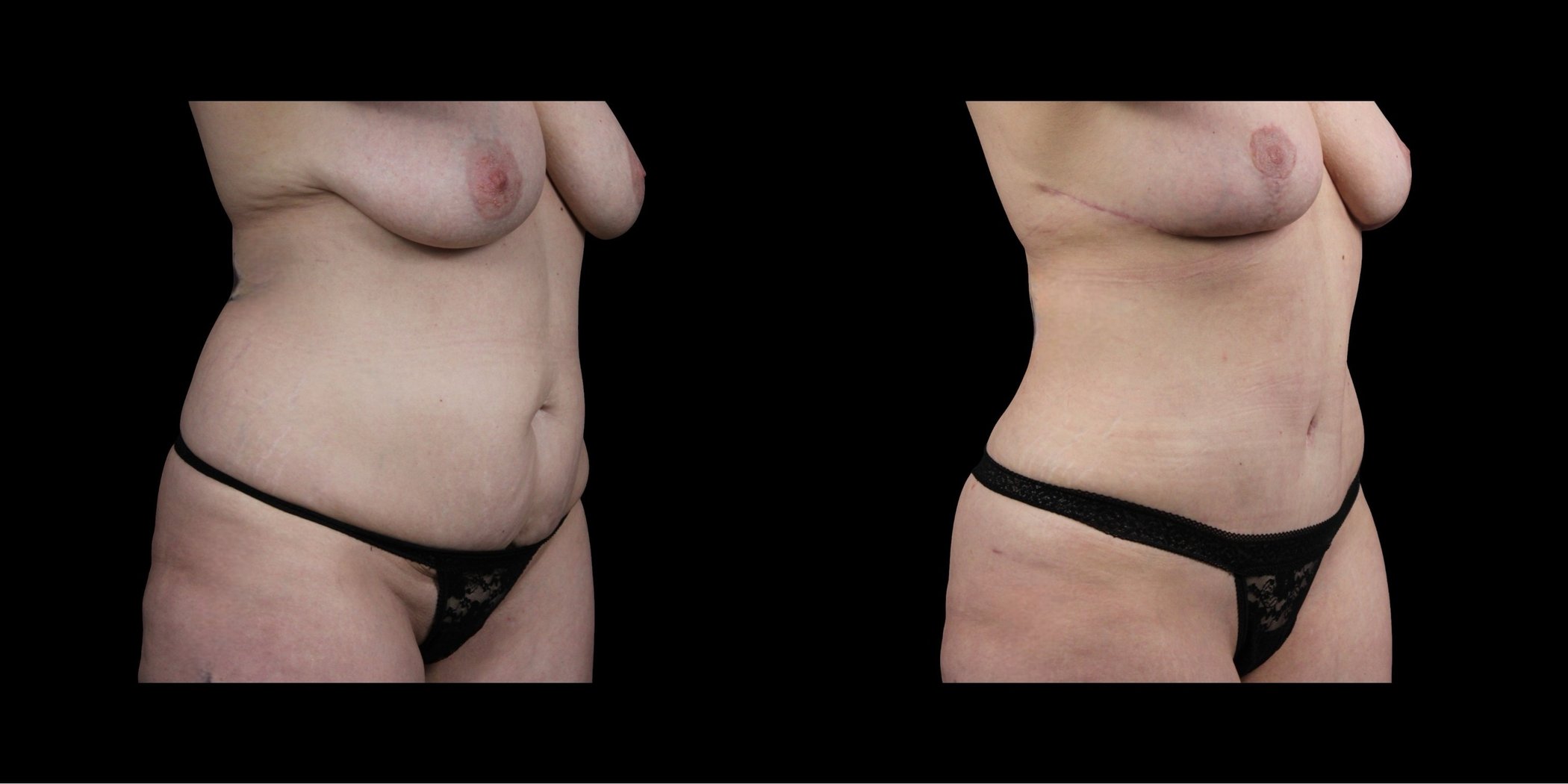 Abdominoplasty before-and-after composite, Consona Plastic Surgery – case 2, view 2