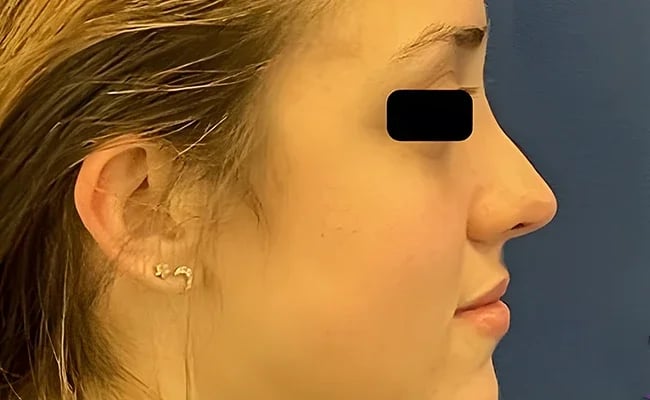 Rhinoplasty before surgery – Murrieta Facial Plastic Surgery, case 10