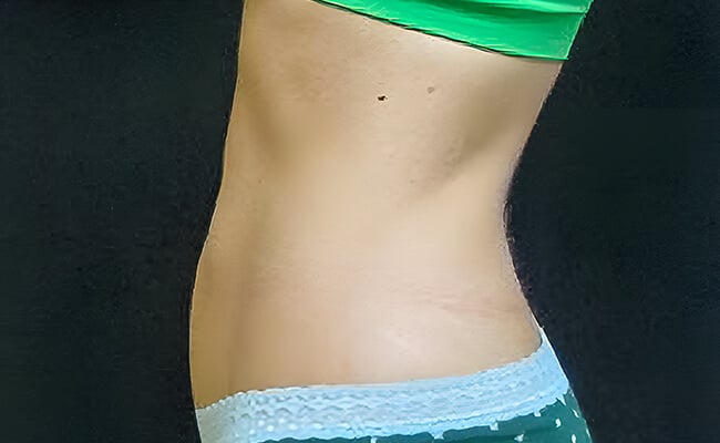 Liposuction after surgery – Murrieta Facial Plastic Surgery, case 4