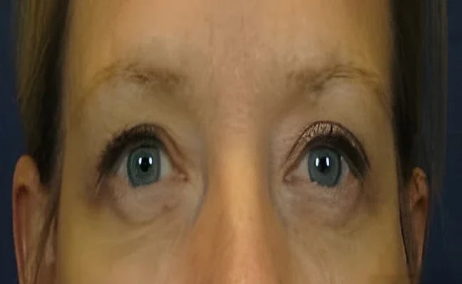 Eyelid Surgery after surgery – Murrieta Facial Plastic Surgery, case 24