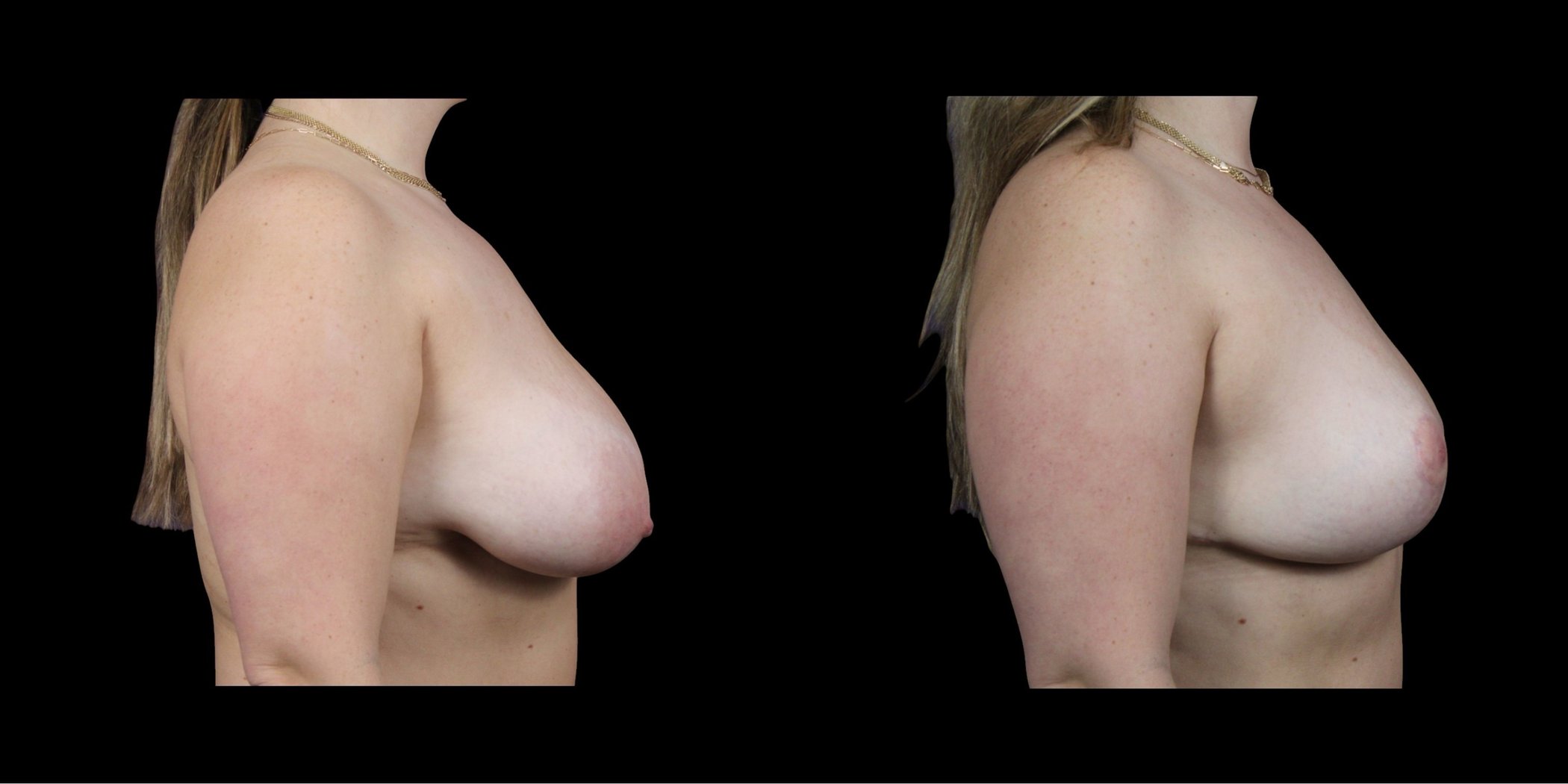 Breast Lift before-and-after composite, Consona Plastic Surgery – case 2, view 3
