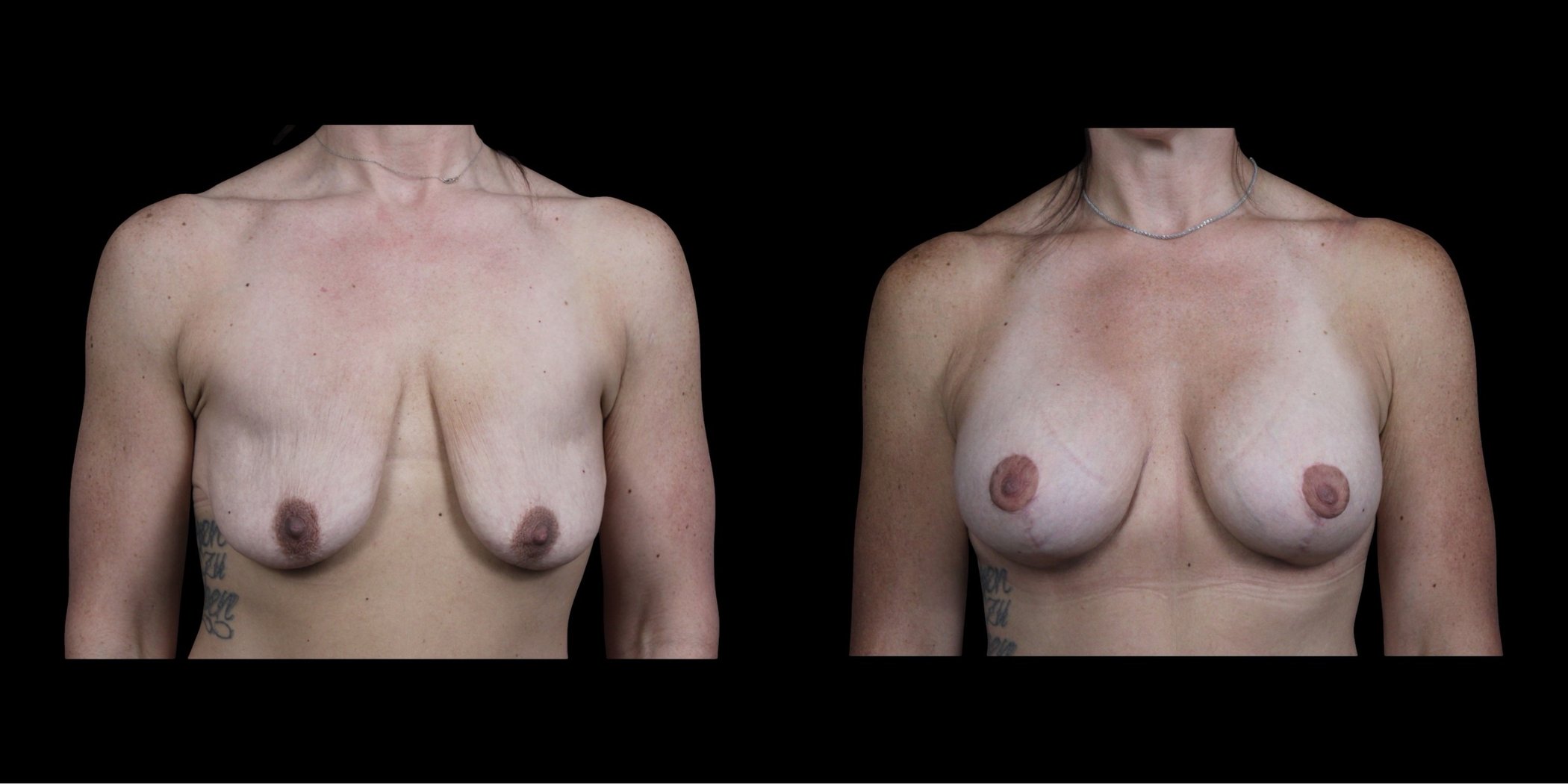 Augmentation Mastopexy before-and-after composite, Consona Plastic Surgery – case 4, view 1
