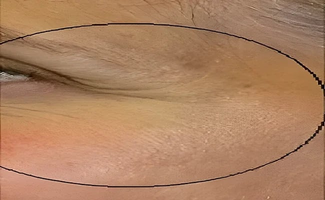 Eyelid Surgery before surgery – Murrieta Facial Plastic Surgery, case 10