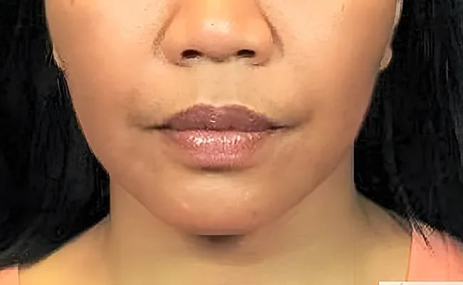 Facelift after surgery – Murrieta Facial Plastic Surgery, case 28