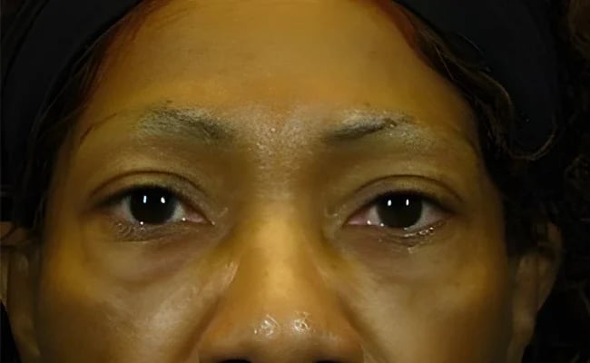 Eyelid Surgery before surgery – Murrieta Facial Plastic Surgery, case 17