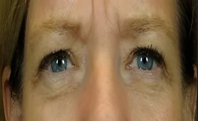 Eyelid Surgery before surgery – Murrieta Facial Plastic Surgery, case 24
